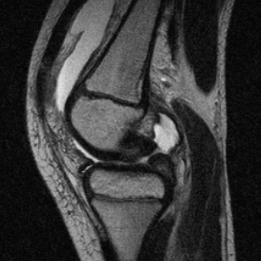 File:Anterior cruciate ligament avulsion fracture (Radiopaedia 24710-24974 Sagittal T2 4).jpg