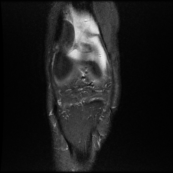 File:Anterior cruciate ligament graft tear and bucket-handle tear of medial meniscus (Radiopaedia 75867-87254 Coronal PD fat sat 6).jpg