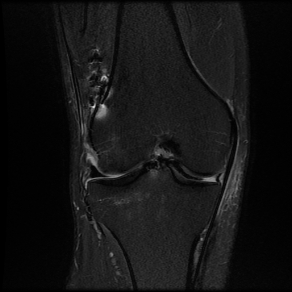 File:Anterior cruciate ligament graft tear and bucket-handle tear of medial meniscus (Radiopaedia 75867-87255 Coronal PD fat sat 14).jpg