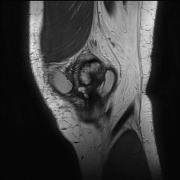 Anterior cruciate ligament rupture with Segond fracture (Radiopaedia 69043-78806 Sagittal PD 30).jpg