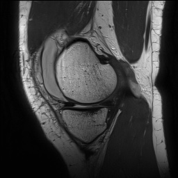 Anterior cruciate ligament rupture with Segond fracture (Radiopaedia 69043-78806 Sagittal PD 54).jpg