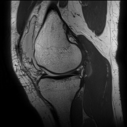 Anterior cruciate ligament rupture with Segond fracture (Radiopaedia 69043-78806 Sagittal PD 70).jpg