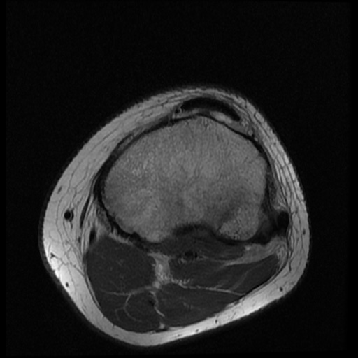 File:Anterior cruciate ligament tear (Radiopaedia 61500-69462 Axial PD 19).jpg