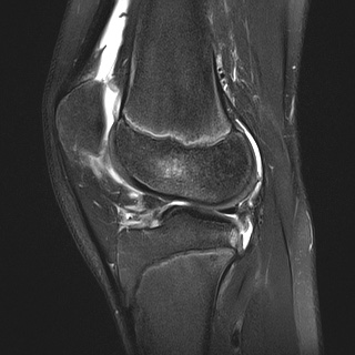 File:Anterior cruciate ligament tear - pediatric (Radiopaedia 62152-70260 Sagittal PD fat sat 23).jpg