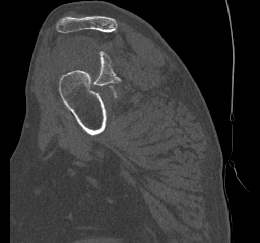 Anterior glenohumeral dislocation with Hill-Sachs lesion (Radiopaedia 62877-71249 Sagittal bone window 27).jpg