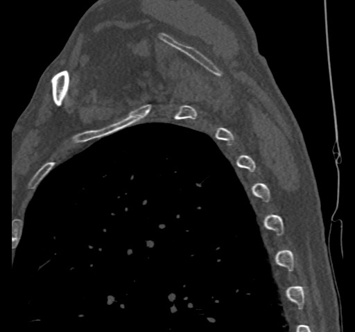 Anterior glenohumeral dislocation with Hill-Sachs lesion (Radiopaedia 62877-71249 Sagittal bone window 59).jpg