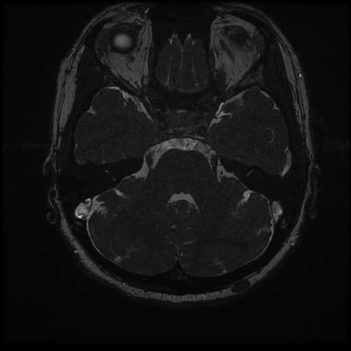 Anterior inferior cerebellar artery vascular loop - type II (Radiopaedia 70991-81209 Axial 3D FIESTA 20).jpg
