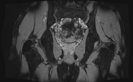 Anterior inferior iliac spine avulsion fracture (Radiopaedia 81312-95000 G 16).jpg