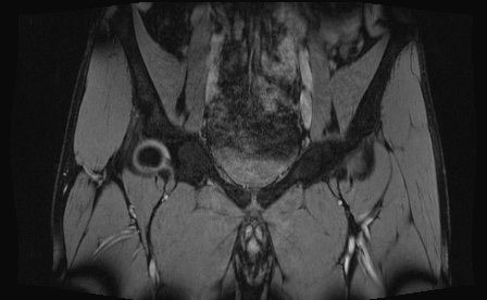 Anterior inferior iliac spine avulsion fracture (Radiopaedia 81312-95000 G 68).jpg