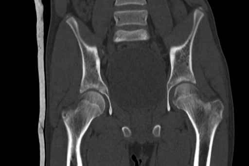 Anterior inferior iliac spine avulsion injury (Radiopaedia 88666-105376 Coronal bone window 37).jpg