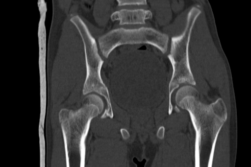Anterior inferior iliac spine avulsion injury (Radiopaedia 88666-105376 Coronal bone window 40).jpg