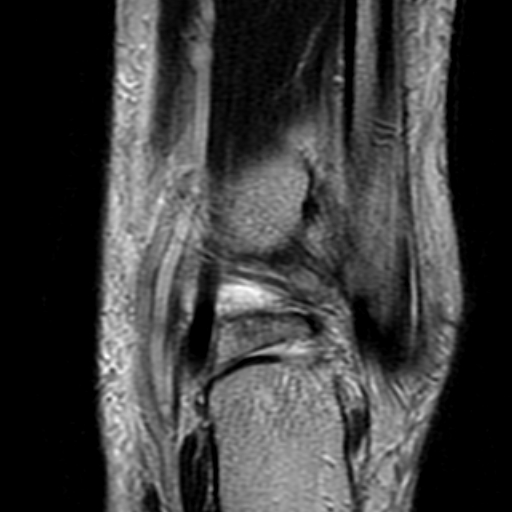 File:Anterior talofibular ligament rupture (Radiopaedia 15831-15484 Coronal T2 17).jpg