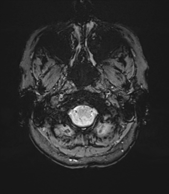 Anterior temporal lobe perivascular space (Radiopaedia 40946-43650 Axial SWI 6).png