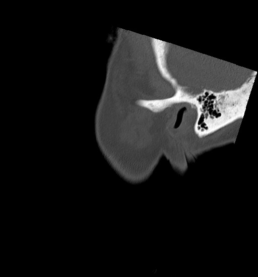 Anterior temporomandibular joint dislocation (Radiopaedia 59430-66784 B 62).jpg