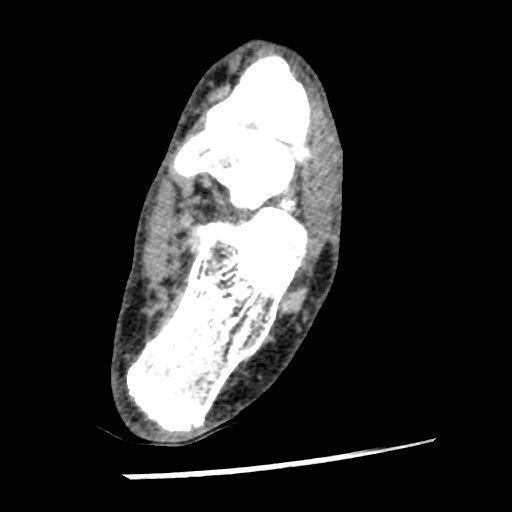 Anterior tibial artery false aneurysm (Radiopaedia 88984-105809 A 179).jpg