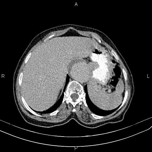 Aortic aneurysm and Lemmel syndrome (Radiopaedia 86499-102554 Axial C+ delayed 15).jpg
