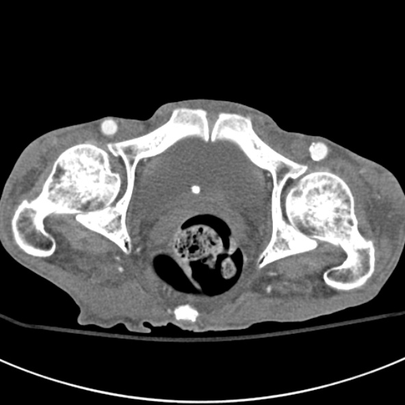 File:Aortic aneurysm with spinal destruction (Radiopaedia 42301-45410 A 109).jpg