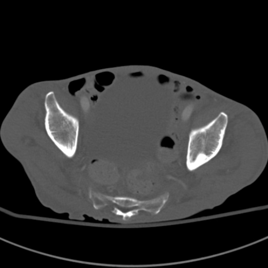 Aortic aneurysm with spinal destruction (Radiopaedia 42301-45410 Axial bone window 94).jpg