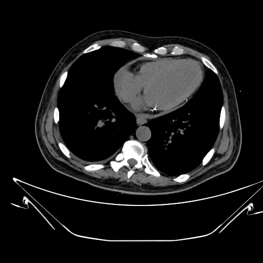 Aortic arch aneurysm (Radiopaedia 84109-99365 Axial non-contrast 189).jpg
