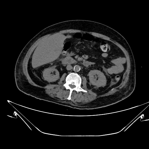 File:Aortic arch aneurysm (Radiopaedia 84109-99365 Axial non-contrast 350).jpg