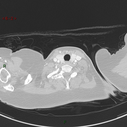 Aortic arch origin of left vertebral artery (Radiopaedia 51520-57286 Axial lung window 2).jpg
