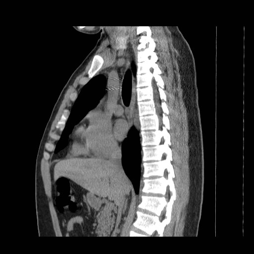 File:Aortic arch stent (Radiopaedia 30030-30595 B 5).jpg