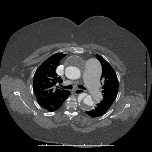 File:Aortic dissection- Stanford A (Radiopaedia 35729-37268 A 30).jpg