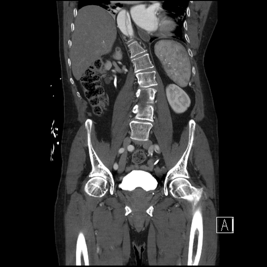 File:Aortic dissection (CTPA) (Radiopaedia 75506-86750 F 43).jpg