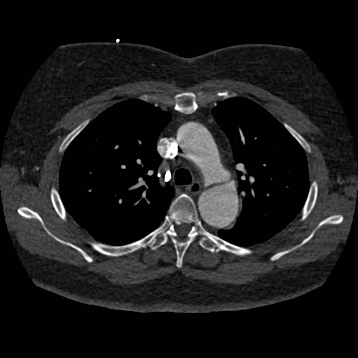 File:Aortic dissection (Radiopaedia 57969-64959 A 111).jpg