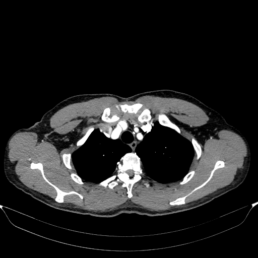 Aortic dissection - Stanford type A (Radiopaedia 83418-98500 A 12).jpg