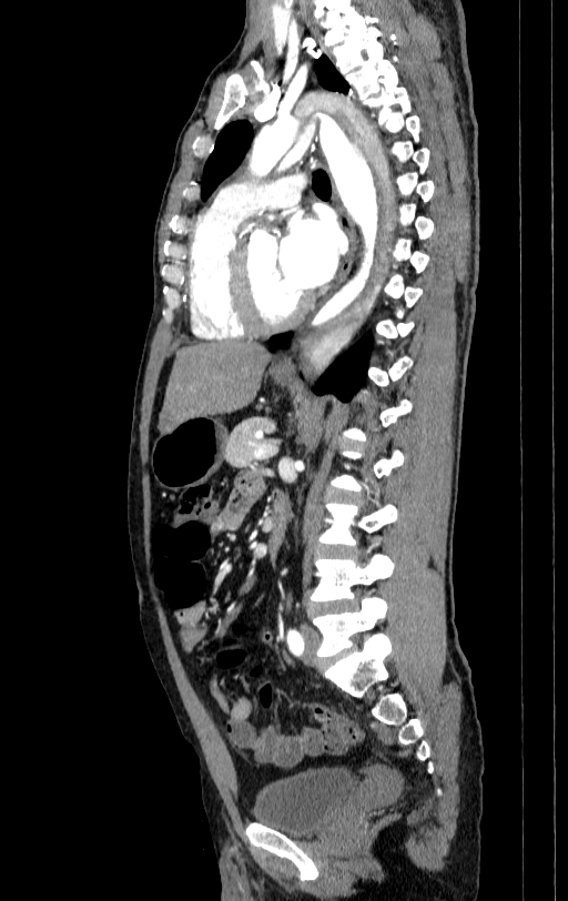 Aortic dissection - Stanford type A (Radiopaedia 83418-98500 B 45).jpg