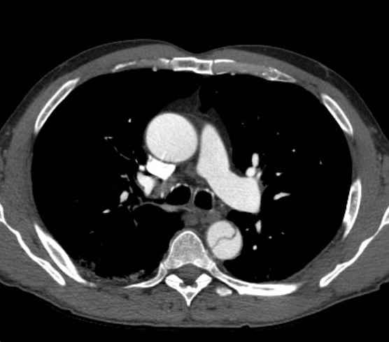 Aortic dissection - Stanford type B (Radiopaedia 73648-84437 A 38).jpg