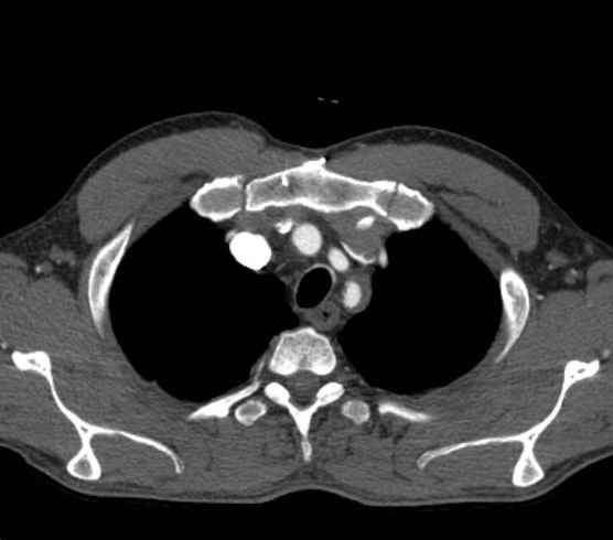 Aortic dissection - Stanford type B (Radiopaedia 73648-84437 A 5).jpg