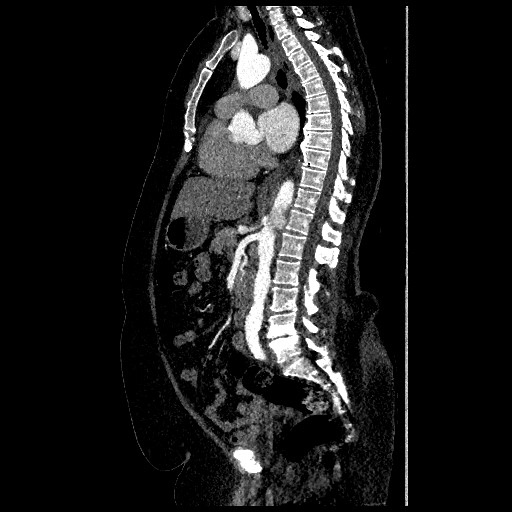 File:Aortic dissection - Stanford type B (Radiopaedia 88281-104910 C 39).jpg
