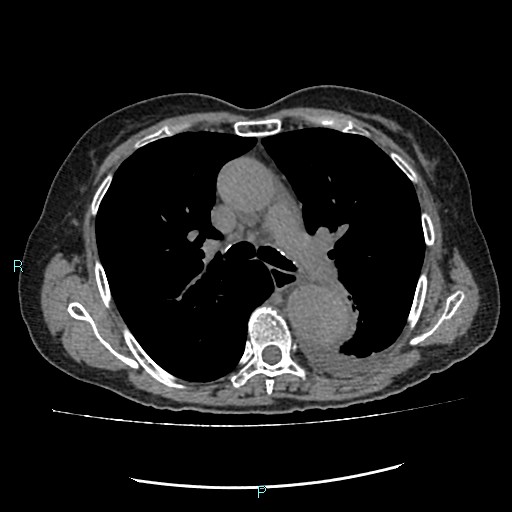 File:Aortic dissection extended to lusory artery (Radiopaedia 43686-47136 Axial non-contrast 12).jpg