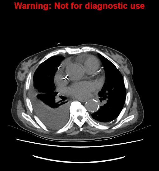 Aortic graft infection (Radiopaedia 44979-48907 Axial non-contrast 2).jpg