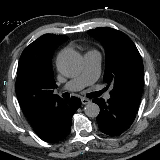 Aortic intramural hematoma (Radiopaedia 48463-53380 Axial non-contrast 74).jpg