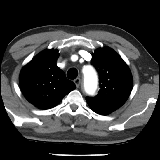 Aortic intramural hematoma (type B) (Radiopaedia 79323-92387 B 10).jpg