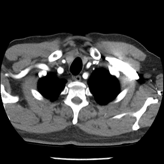 Aortic intramural hematoma (type B) (Radiopaedia 79323-92387 B 3).jpg