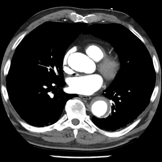 Aortic intramural hematoma (type B) (Radiopaedia 79323-92387 B 31).jpg