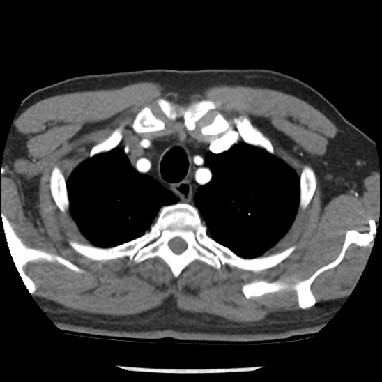 File:Aortic intramural hematoma (type B) (Radiopaedia 79323-92387 B 6).jpg