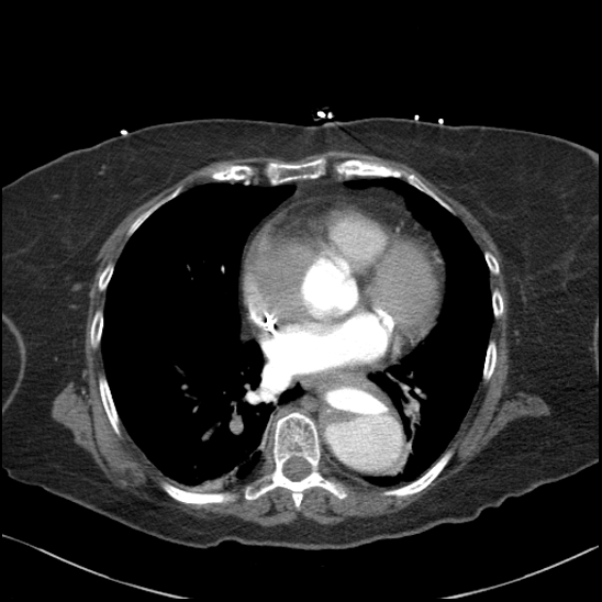 Aortic intramural hematoma with dissection and intramural blood pool (Radiopaedia 77373-89491 B 70).jpg