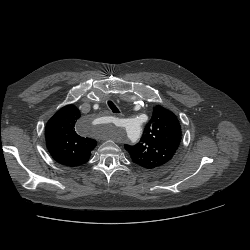 File:Aorto-coronary bypass graft aneurysms (Radiopaedia 40562-43157 A 25).png