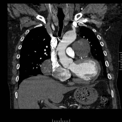 File:Aorto-coronary bypass graft aneurysms (Radiopaedia 40562-43157 B 18).png