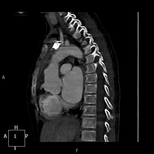 File:Aortopulmonary septal defect (Radiopaedia 41990-45013 Sagittal C+ CTPA 26).jpg