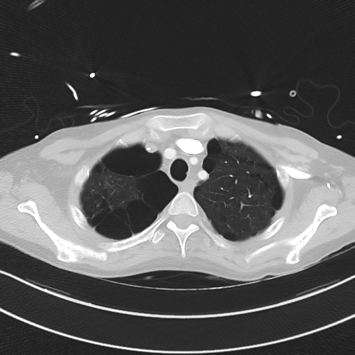Apical bullous disease in a heavy smoker (Radiopaedia 33067-34092 Axial lung window 13).png