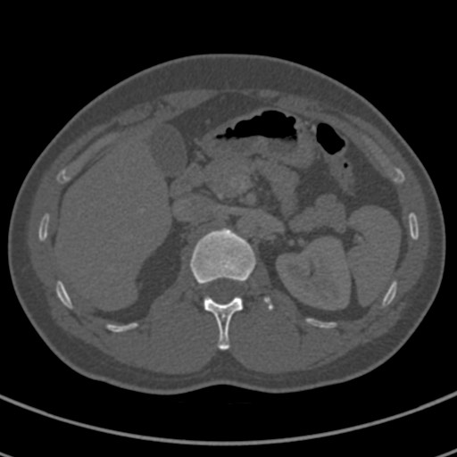 Apical lung mass mimic - neurogenic tumor (Radiopaedia 59918-67521 Axial bone window 90).jpg
