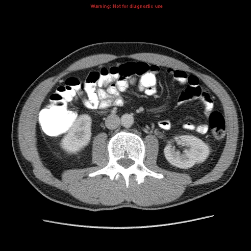File:Appendicitis and renal cell carcinoma (Radiopaedia 17063-16760 A 28).jpg