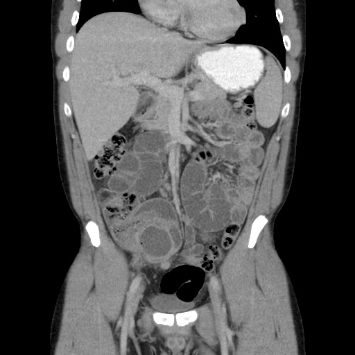 Appendicitis complicated by post-operative collection (Radiopaedia 35595-37114 B 23).jpg