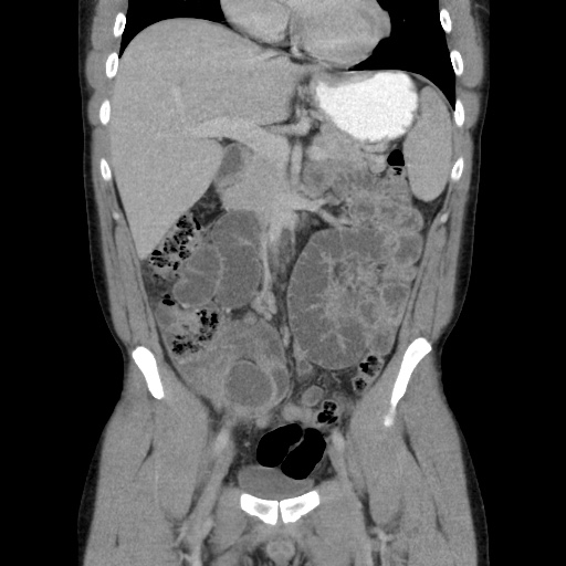 Appendicitis complicated by post-operative collection (Radiopaedia 35595-37114 B 24).jpg
